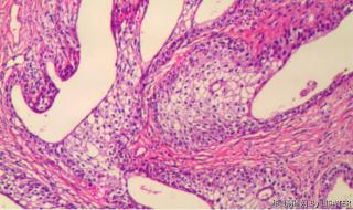 前列腺组织、膀胱肿物图8
