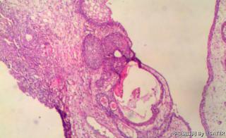前列腺组织、膀胱肿物图14