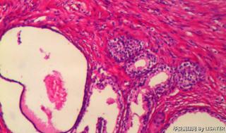 前列腺组织、膀胱肿物图1
