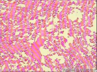 室管膜胶质瘤图2
