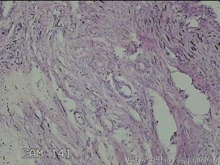 子宫颈管内膜图21