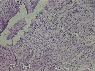 子宫粘膜下肌瘤图27