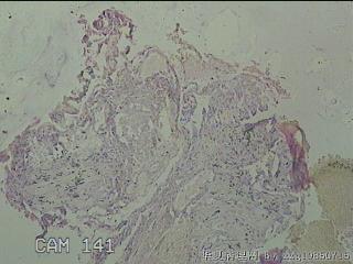子宫粘膜下肌瘤图14
