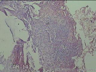 子宫粘膜下肌瘤图8