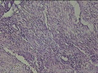 子宫粘膜下肌瘤图28
