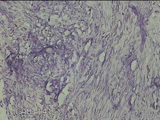 子宫粘膜下肌瘤图19