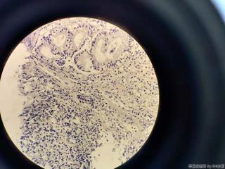 重度贫血 结肠活检，内镜高度疑腺癌，镜下够吗？图7
