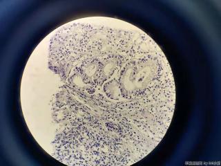 重度贫血 结肠活检，内镜高度疑腺癌，镜下够吗？图1