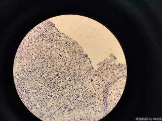重度贫血 贲门取活检图1