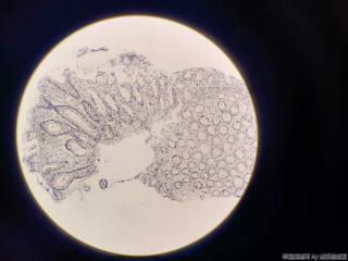 直肠取活检，增生性息肉？图4