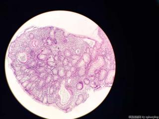 结肠肠镜呈鹅卵石样改变，如何考虑？图9