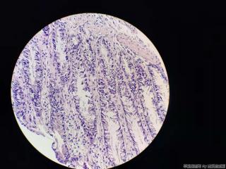结肠活检，有问题吗？图14