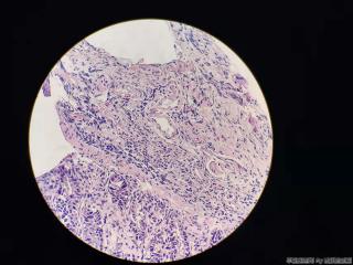 结肠活检，有问题吗？图11