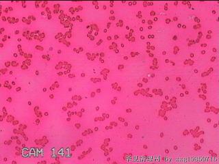 甲状腺细针穿刺涂片图31