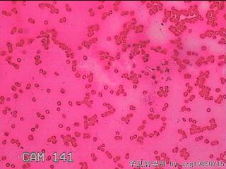 甲状腺细针穿刺涂片图22