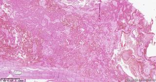 乳头状肾细胞癌，2型？图2