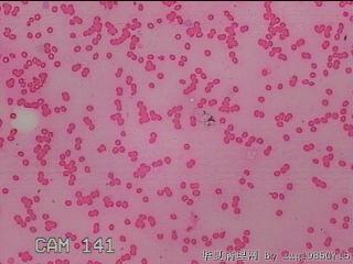 甲状腺细针穿刺涂片图15