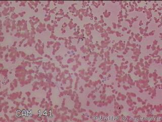 甲状腺细针穿刺涂片图13