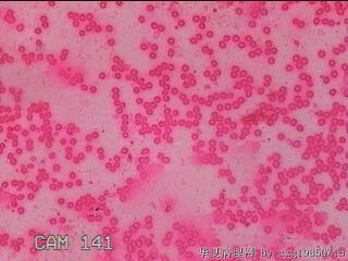 甲状腺细针穿刺涂片图11