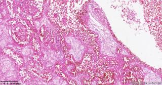 乳头状肾细胞癌，2型？图3
