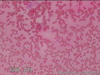 甲状腺细针穿刺涂片图32