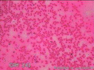 甲状腺细针穿刺涂片图10