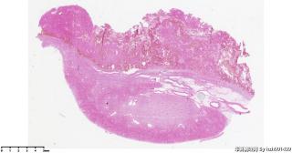 乳头状肾细胞癌，2型？图1