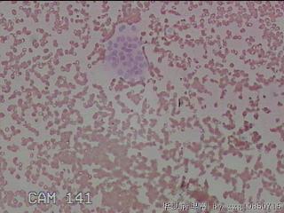 甲状腺细针穿刺涂片图14