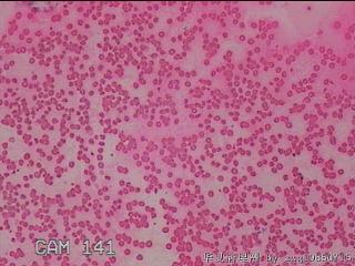 甲状腺细针穿刺涂片图9