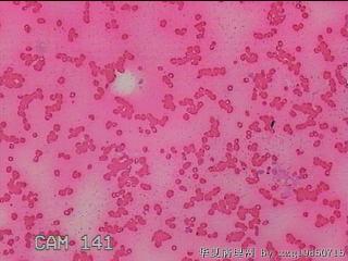 甲状腺细针穿刺涂片图30