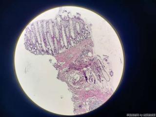 升结肠至直肠多灶糜烂图3