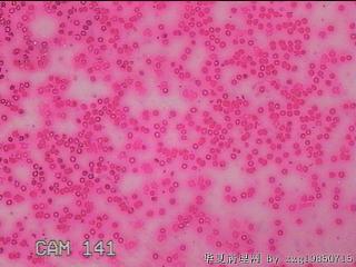 左侧甲状腺细针穿刺涂片图10