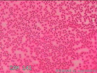 左侧甲状腺细针穿刺涂片图8