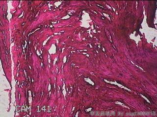 子宫体肌瘤图15