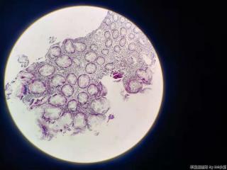 结肠十余枚息肉，有肠腺癌家族史图31
