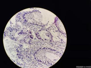 结肠十余枚息肉，有肠腺癌家族史图24