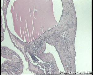 卵巢成熟性畸胎瘤伴浆液性乳头状囊腺瘤吗？图2