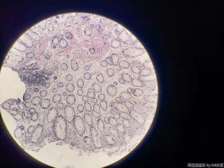 结肠十余枚息肉，有肠腺癌家族史图10