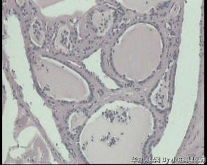 卵巢成熟性畸胎瘤伴浆液性乳头状囊腺瘤吗？图5