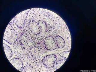 结肠十余枚息肉，有肠腺癌家族史图19
