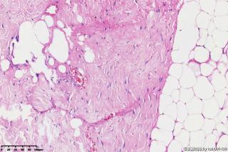 纤维脂肪瘤？图23