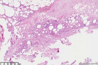 纤维脂肪瘤？图20