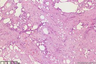 纤维脂肪瘤？图12