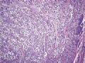 胰腺肿瘤 －  实性假乳头状肿瘤,透明细胞型图1