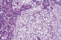 胰腺肿瘤 －  实性假乳头状肿瘤,透明细胞型图2