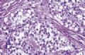 胰腺肿瘤 －  实性假乳头状肿瘤,透明细胞型图3