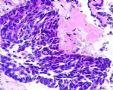 一例特殊的乳腺癌--会诊意见为：乳腺浸润性导管癌2级，考虑可能为纤维腺瘤恶变。图1
