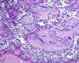 一例特殊的乳腺癌--会诊意见为：乳腺浸润性导管癌2级，考虑可能为纤维腺瘤恶变。图2