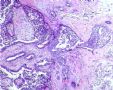 一例特殊的乳腺癌--会诊意见为：乳腺浸润性导管癌2级，考虑可能为纤维腺瘤恶变。图3