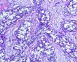 一例特殊的乳腺癌--会诊意见为：乳腺浸润性导管癌2级，考虑可能为纤维腺瘤恶变。图5